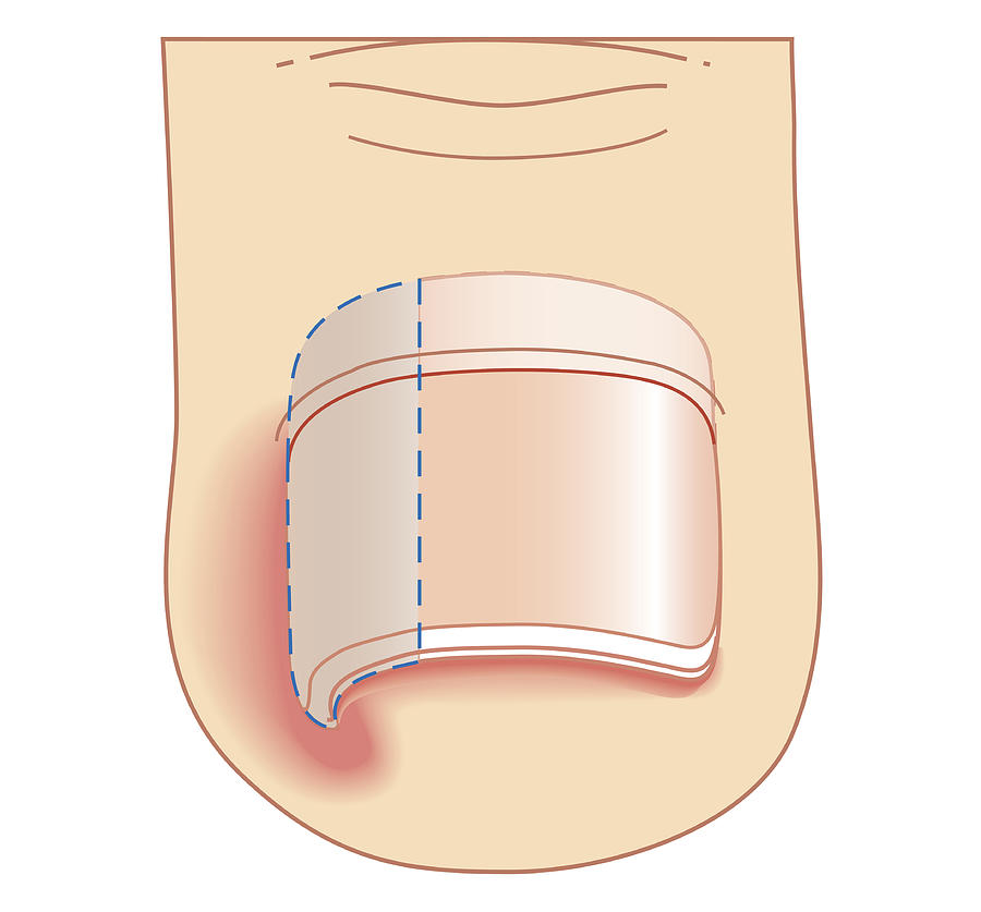 Cross section biomedical illustration of removal site of ingrown toenail (Onychocryptosis) Drawing by Dorling Kindersley