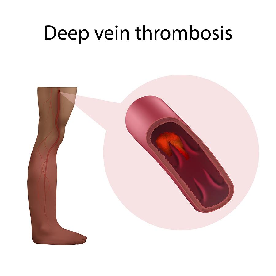 Deep vein thrombosis, illustration Photograph by Veronika Zakharova/science Photo Library