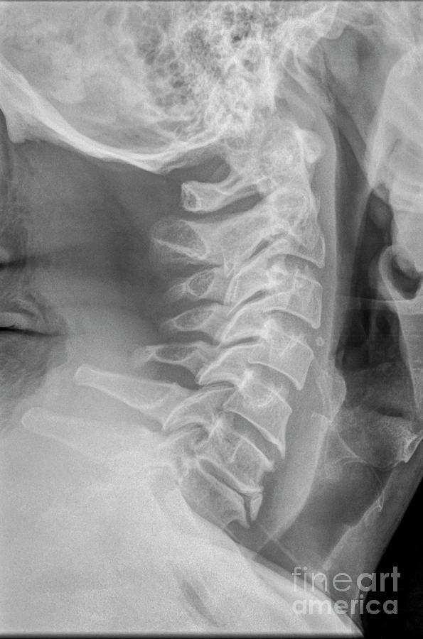 Dens Fracture Cervical Spine X Ray N1 Photograph By Guy Viner