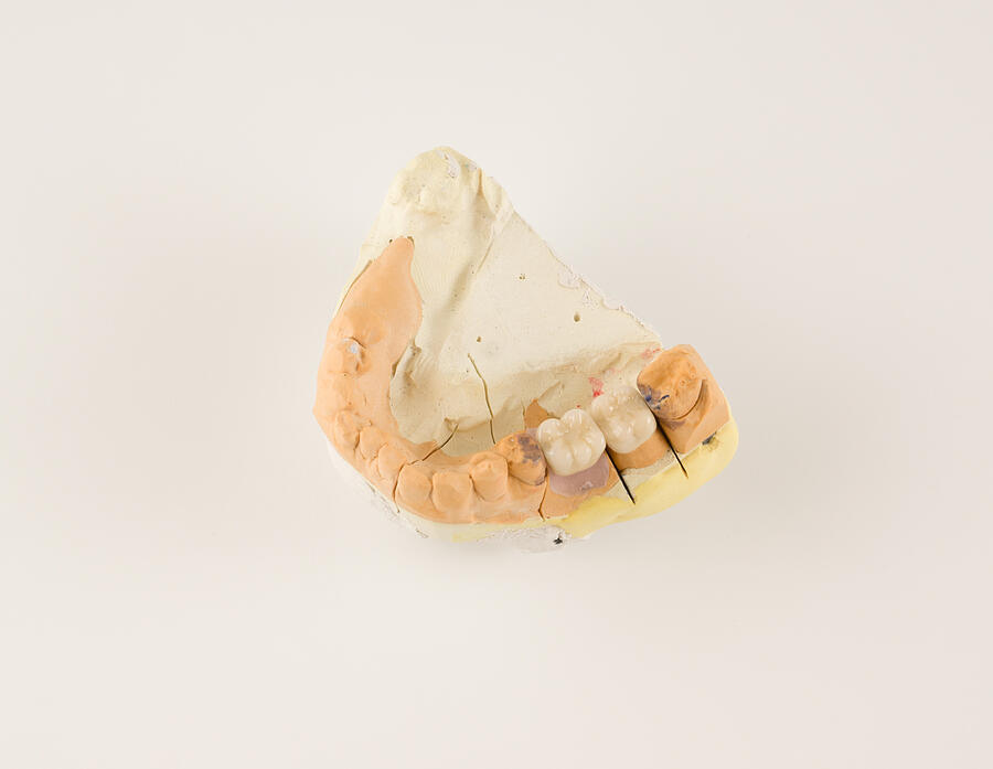 Dental Prosthesis Manufacturing Step Photograph by Krezofen