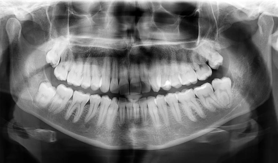 Dental X-Ray of teeth Photograph by Cylonphoto