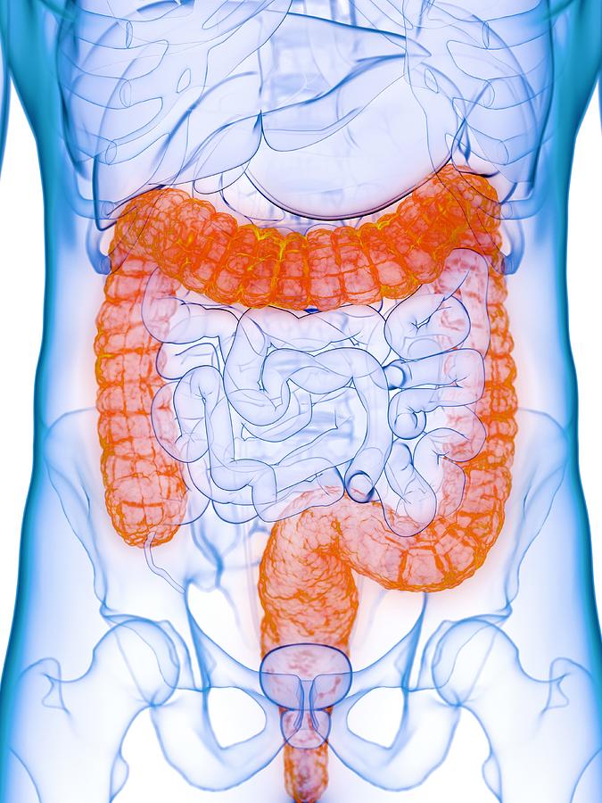 Diseased colon, conceptual illustration Drawing by Sebastian Kaulitzki/science Photo Library