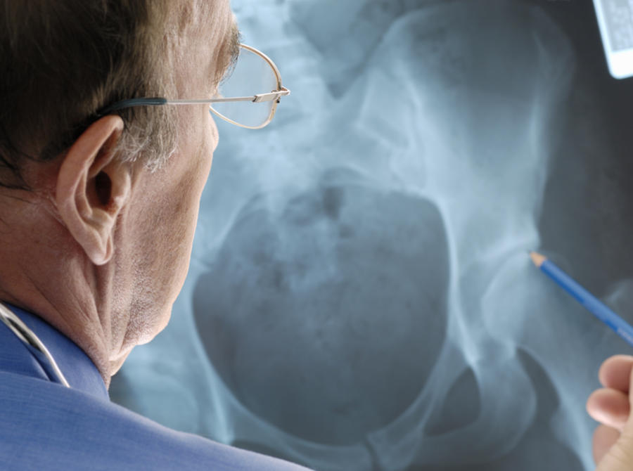Doctor examining osteoporosis on an x-ray. Photograph by Fertnig