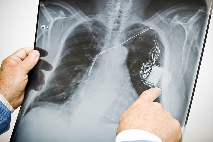 Doctor pointing at pacemaker on chest x-ray Photograph by Mehmed Zelkovic