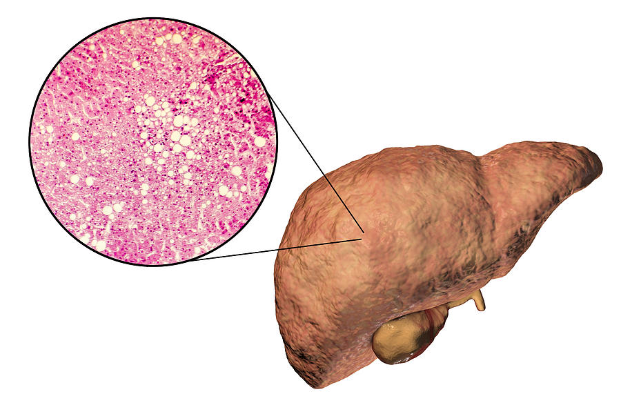 Fatty liver, illustration and micrograph Drawing by Kateryna Kon/science Photo Library