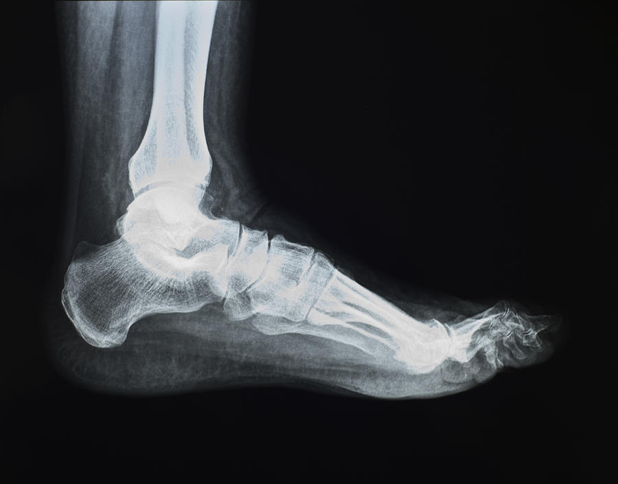 Foot X-ray Photograph by Stevedangers