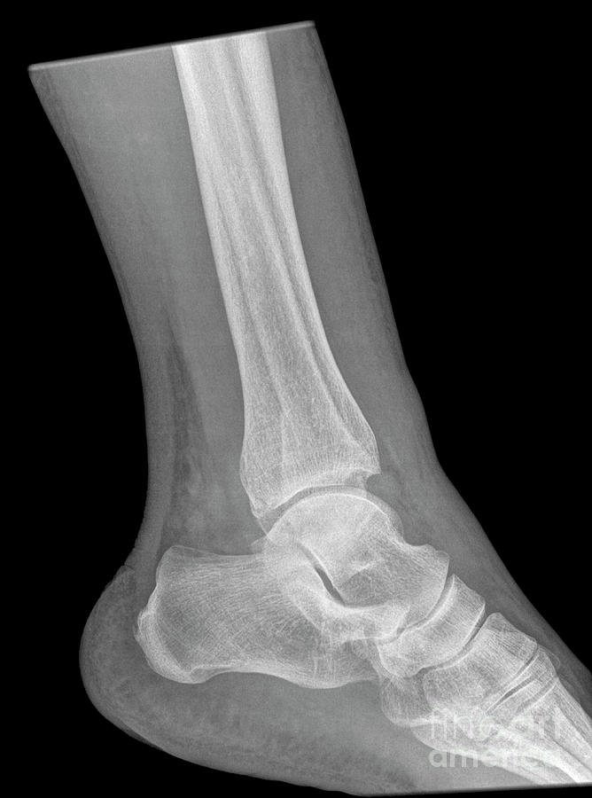Fracture of the distal tibia and fibula n5 Photograph by Guy Viner