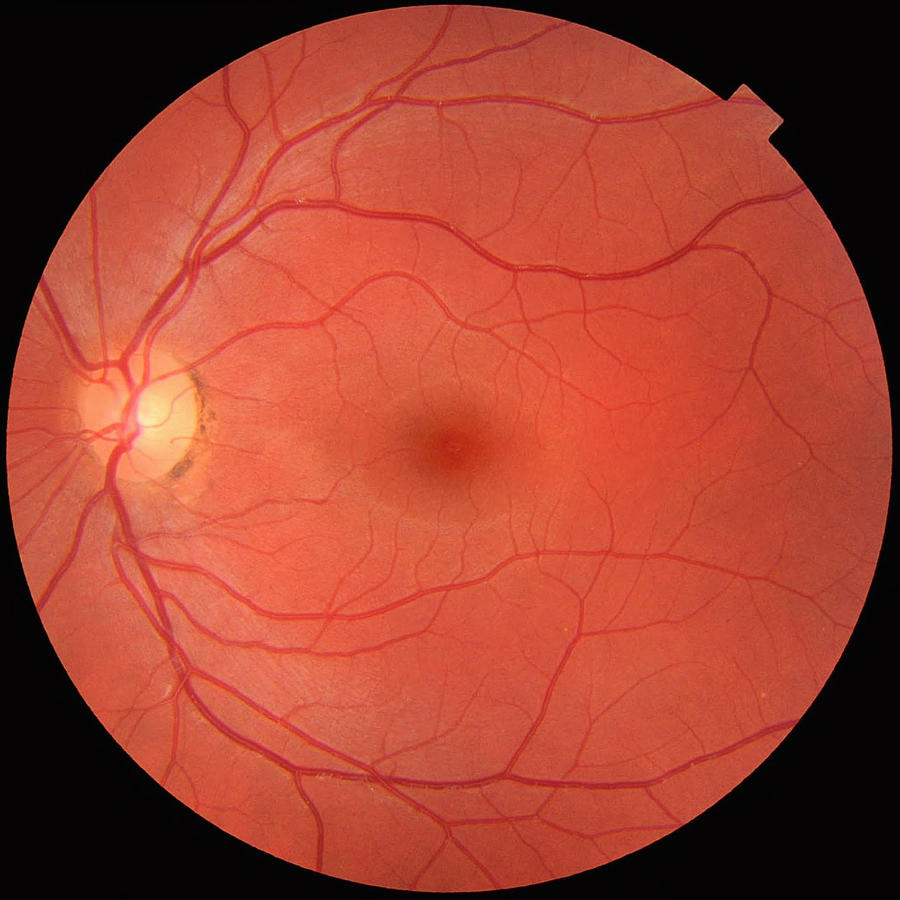 Fundus photograph of a normal left eye. Macula in center and optic disk where blood vessels converge with pigmentation on perimeter Photograph by Callista Images