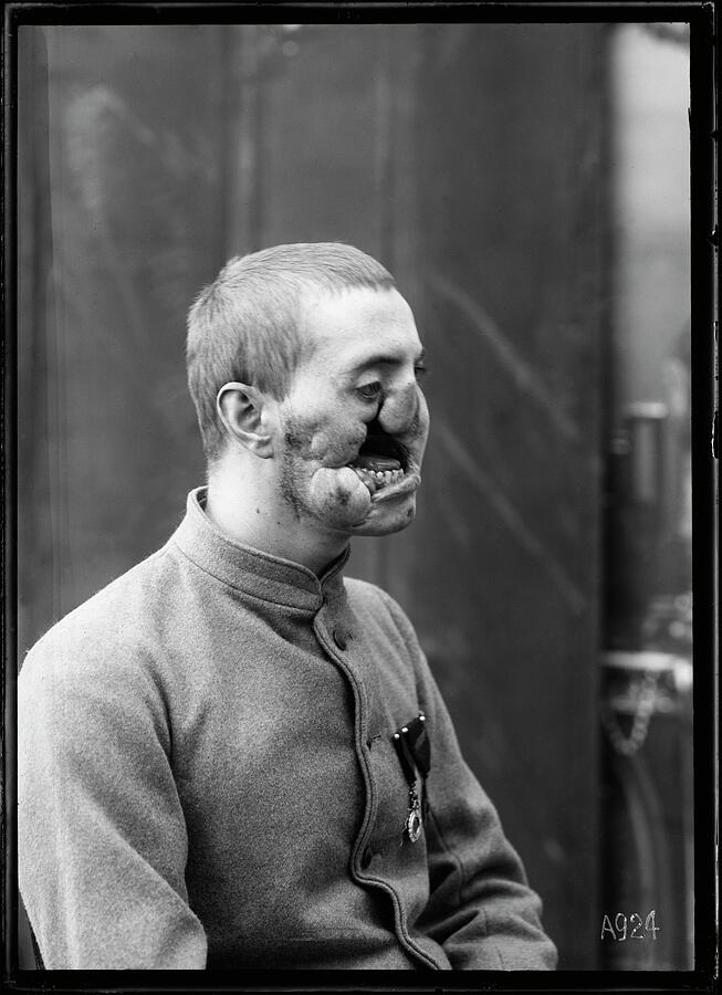 Gueule Cassee, Mutile de Guerre, 1918 Photograph by Croix Rouge - Fine ...