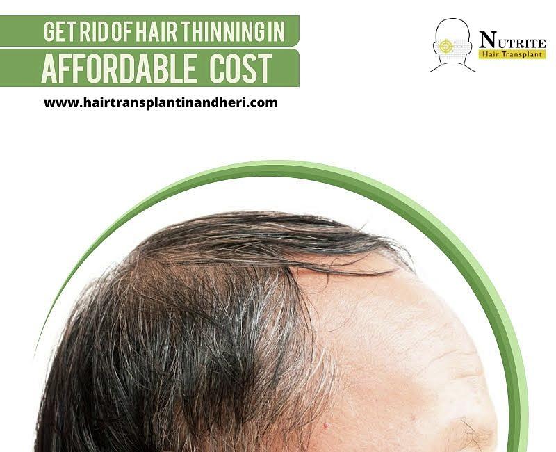 Hair Transplant - Increase Your Hair Growth Photograph by Nubello Clinic -  Fine Art America