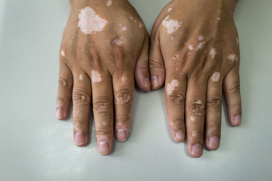 Hand Vitiligo Photograph by HengDao