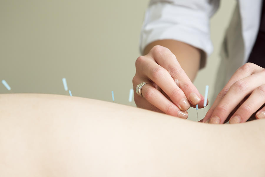 Hands of acupuncture therapist inserting a needle Photograph by Alina555