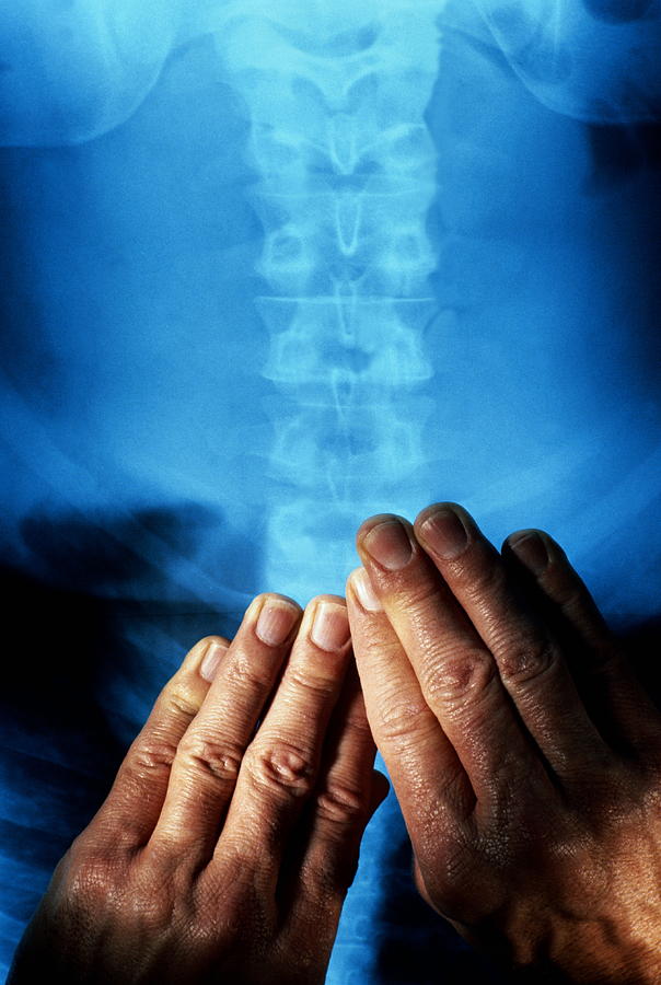 Hands resting on X-ray, as if massaging spine, close-up Photograph by Zigy Kaluzny
