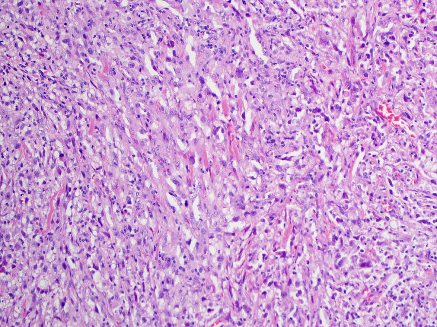 H&E stain, light microscopy, malignant melanoma of skin Photograph by Ucsf