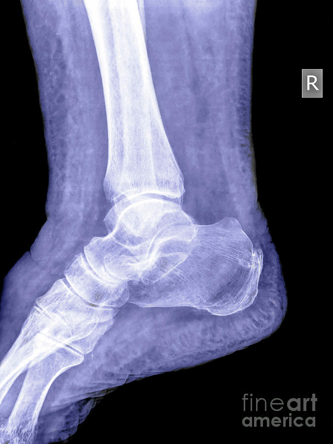 Healthy ankle joint n2 Photograph by Guy Viner