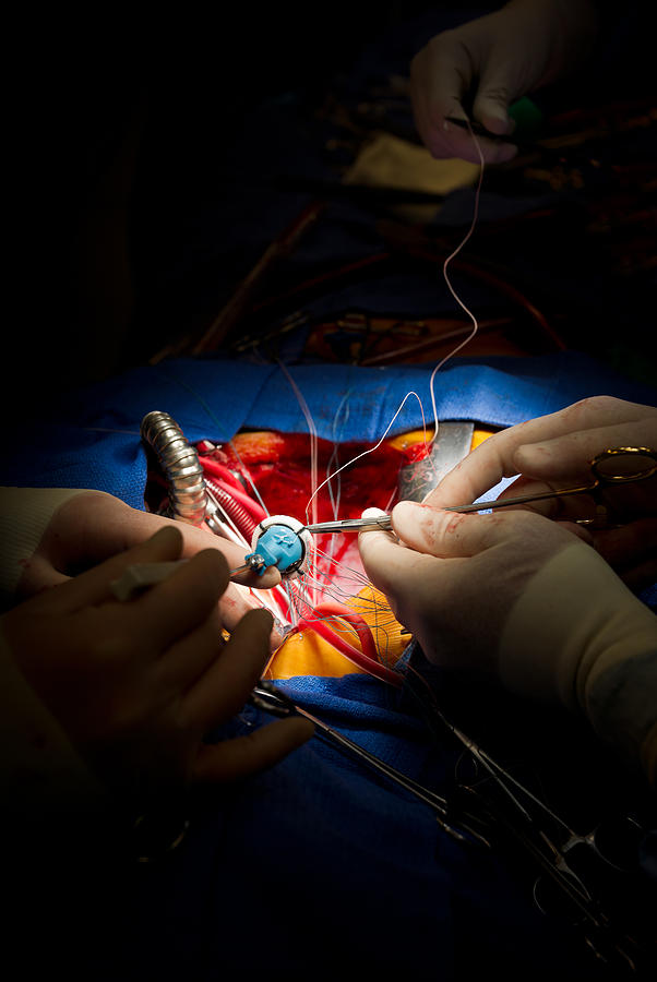 Heart Surgery Mitral Valve Replacement with Mechanical Surrogate Photograph by Miralex