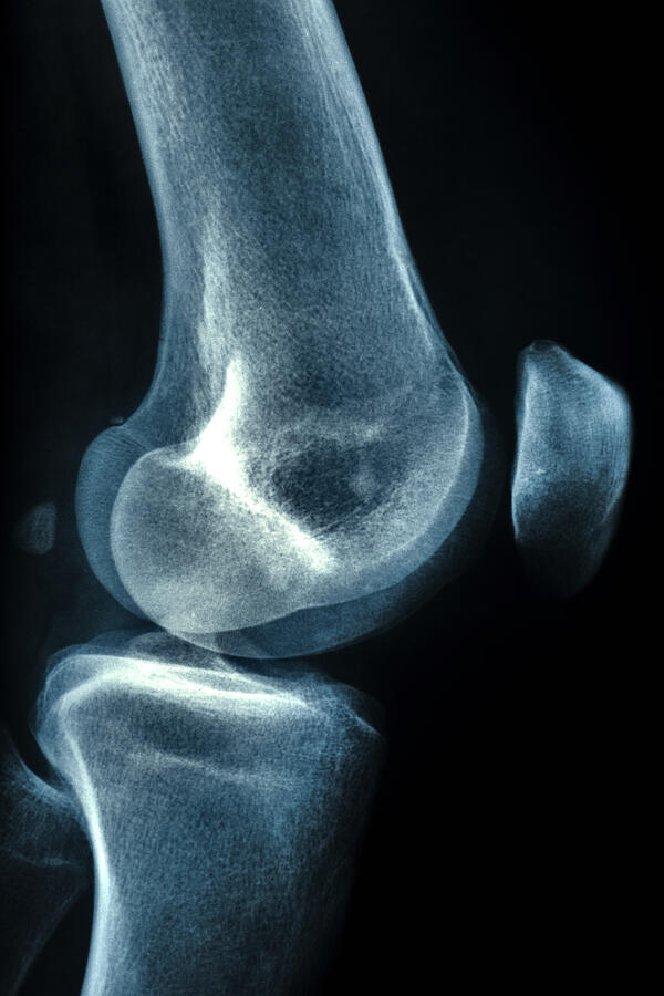 Human knee Photograph by Georg Hanf