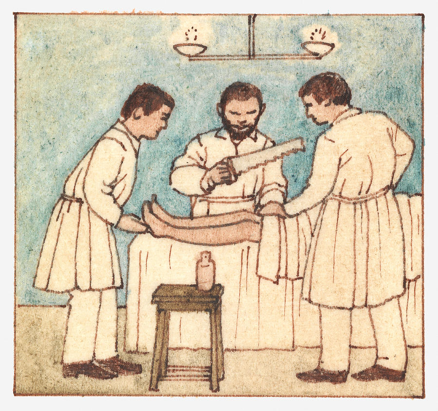 Illustration of ancient surgery techniques, using saw to amputate Drawing by Dorling Kindersley