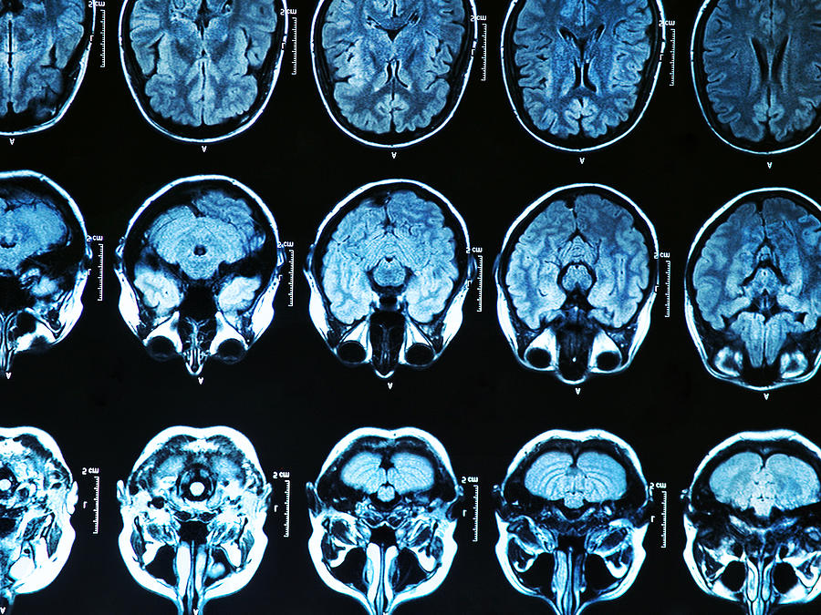 Image of several MRI brain scan images Photograph by Bunyos