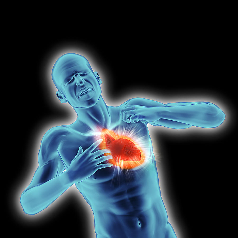 Image representing a heart attack in human male Drawing by Doug Armand