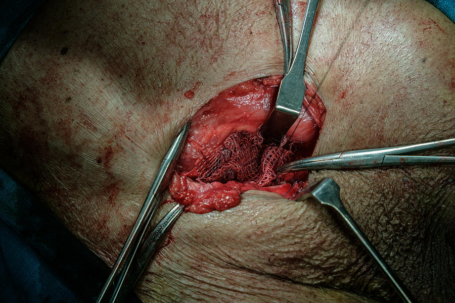 Implant of Polypropylene Mesh for hernia repair (abdominal surgery) Photograph by Kaushik Ghosh