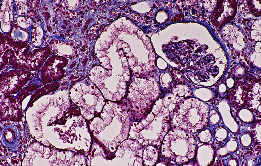 KIDNEY --- NEPHRON, GLOMERULUS, BOWMAN S CAPSULE, KIDNEY TUBULES, 50X. Human. Shows: glomerulus, Bowman s capsule, renal tubules (proximal, distal & loop of Henle) Mallory stain. Photograph by Ed Reschke