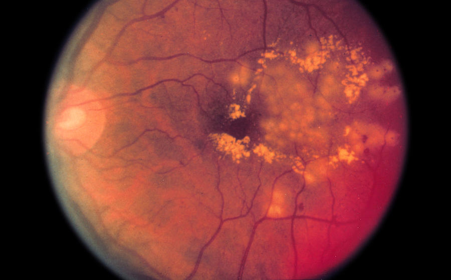 Laser surgery for diabetic retinopathy Photograph by Scott Camazine