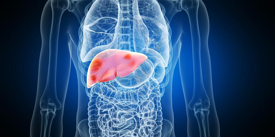 Liver tumours, illustration Drawing by Sebastian Kaulitzki/science Photo Library