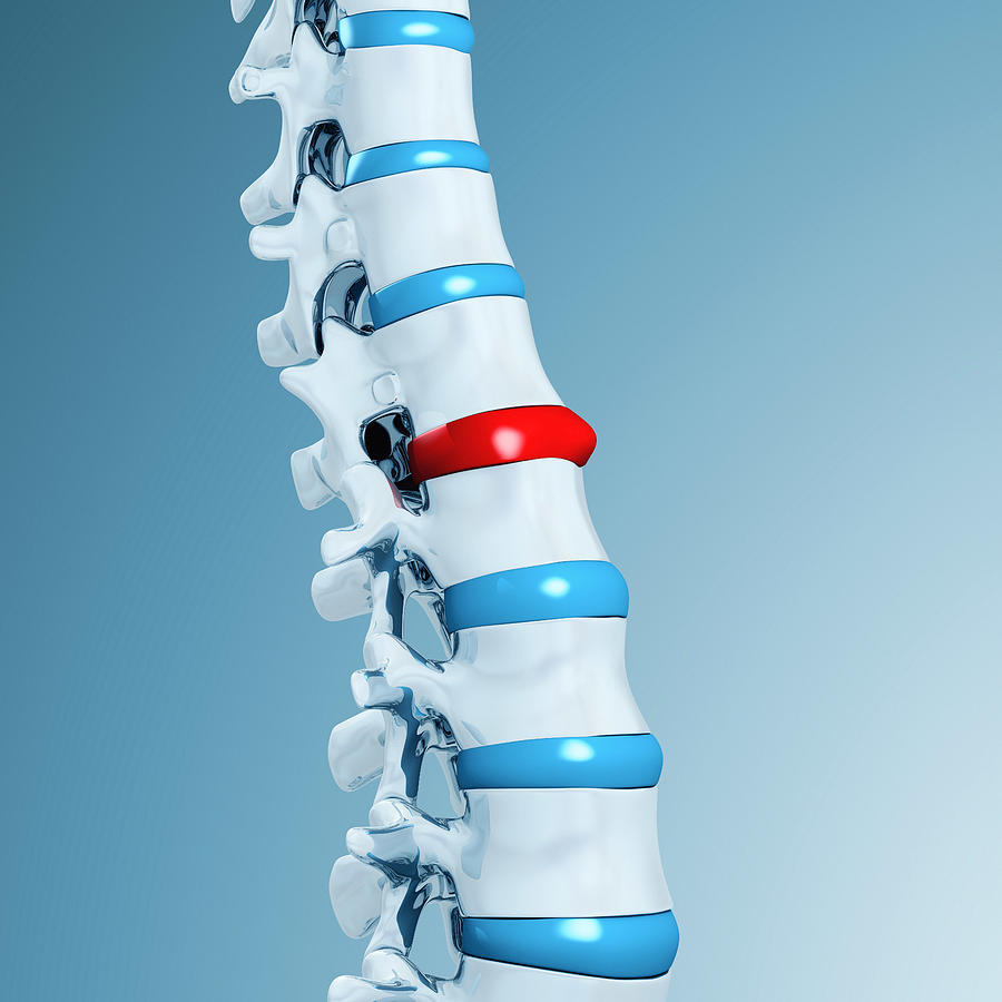 Lumbar Spine With Spinal Disk Photograph by Artpartner-images