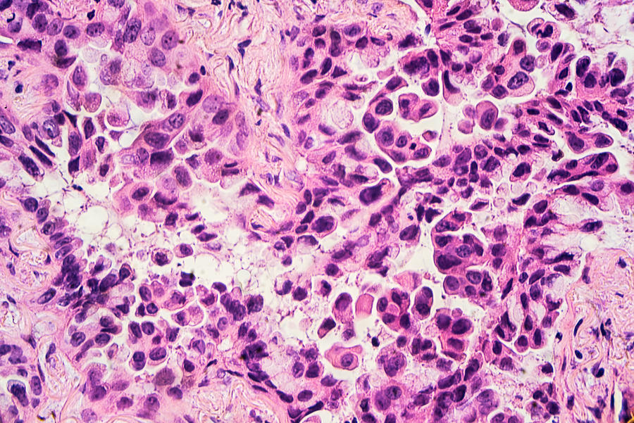 Lung Cancer: Adenocarcinoma Photograph by Rightdx