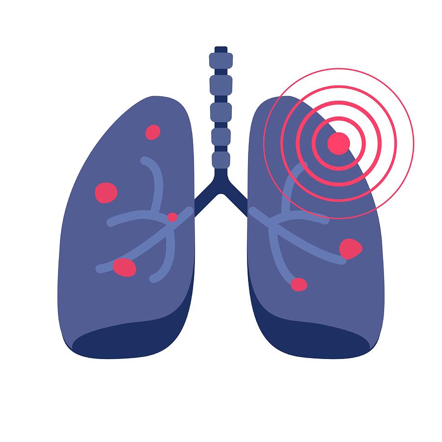 Lungs cancer illness or lung pneumonia and bronchitis tuberculosis pulmonary disease vector flat icon illustration, concept of medicine or medical respiration infection of organ sign isolated Drawing by Vladwel
