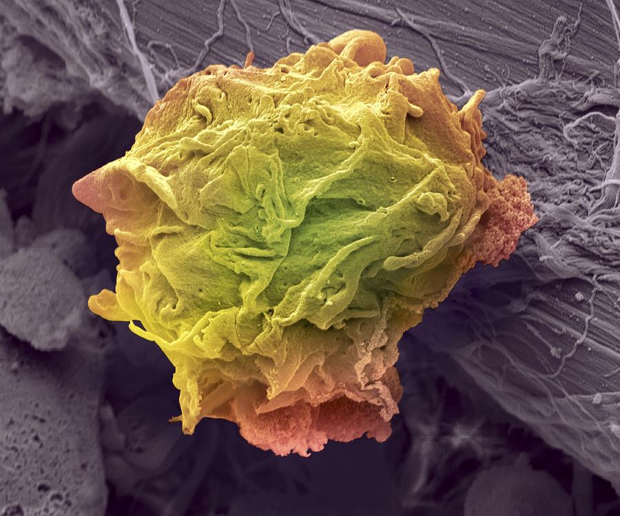 Lymphoma cancer cell, SEM Drawing by Steve Gschmeissner/science Photo Library