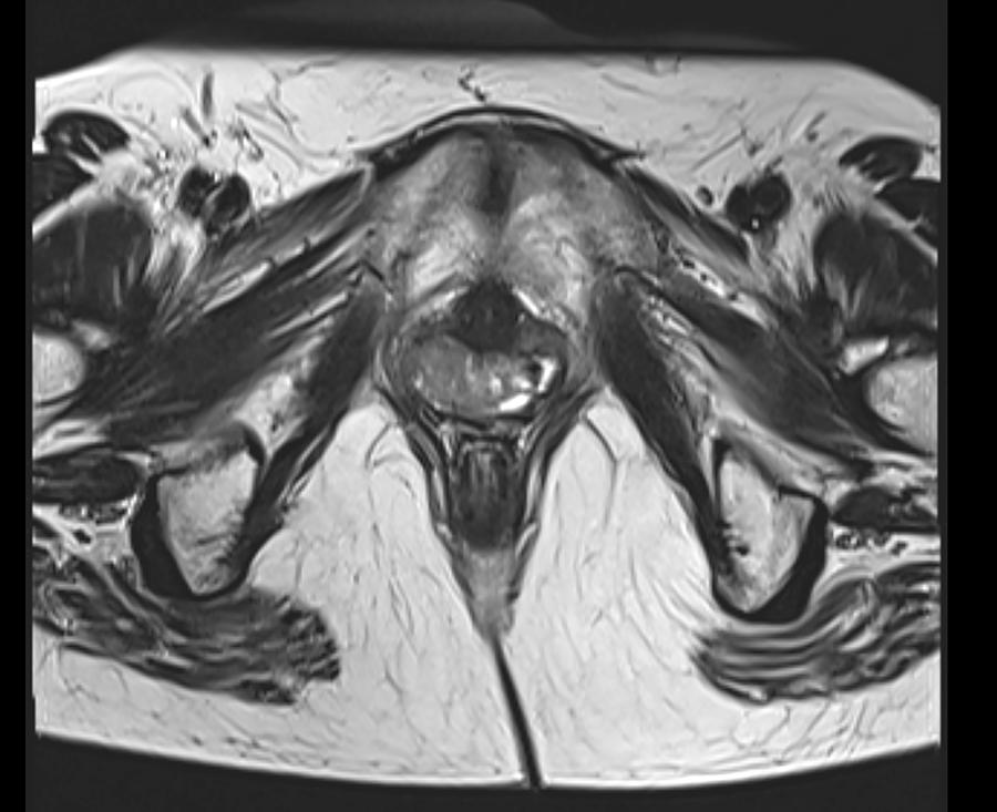 Magnetic Resonance Images of Woman Pelvis with Vaginal cancer, axial T2 view Photograph by Paul Biris