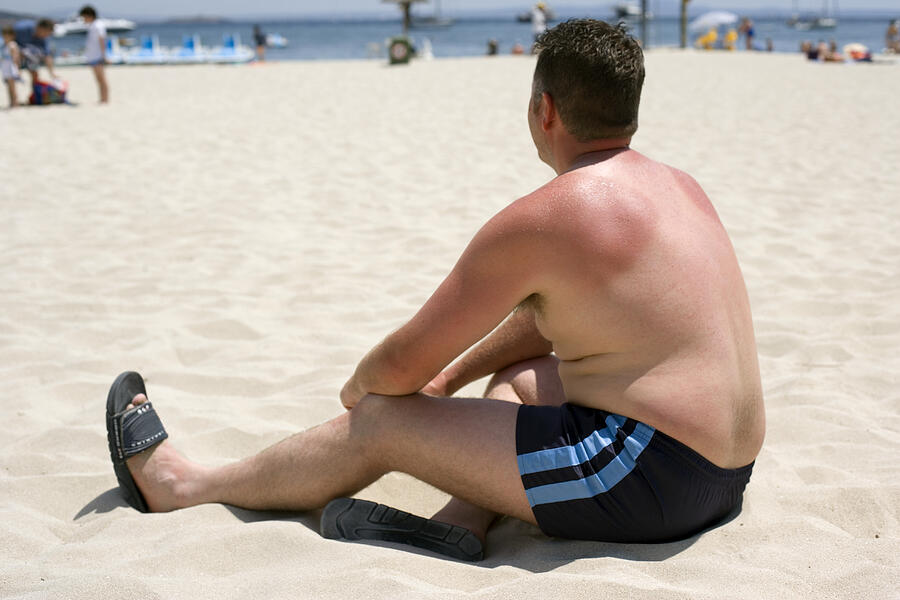 Man with sun burnt shoulders sitting on beach, rear view Photograph by Ian Hooton/spl
