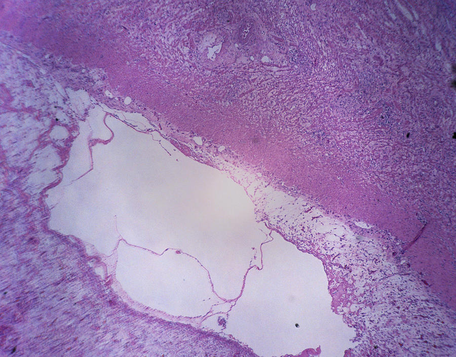 Microscopic Image of a Gastric Ulcer Photograph by Duncan Smith