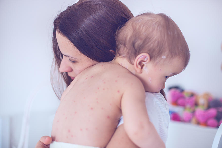Mother taking care of baby with chicken pox Photograph by South_agency