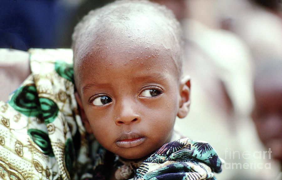 Mother With Malnourished Girl In Dori Burkina Faso African Di 