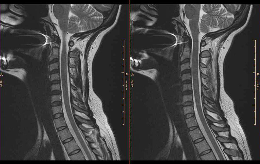 MRI Cervical Spine Photograph by Paul Biris