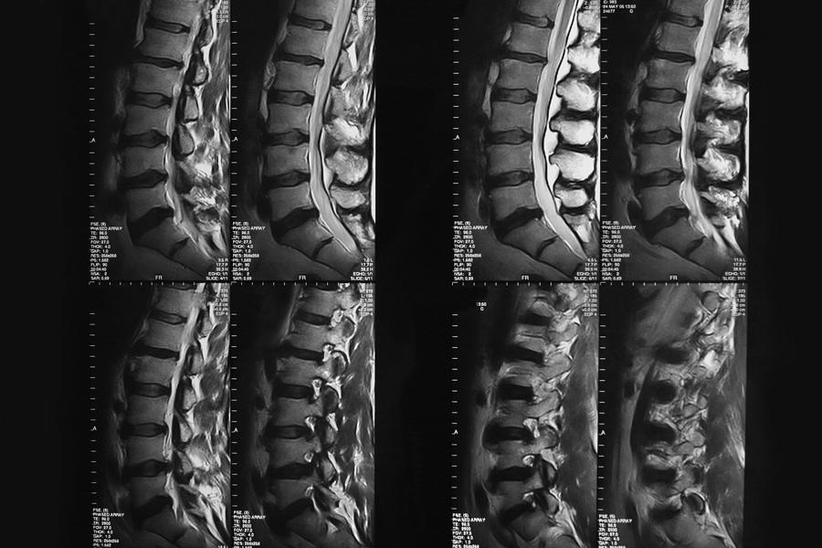 MRI  image of lower back...Vertebral column Photograph by Choja