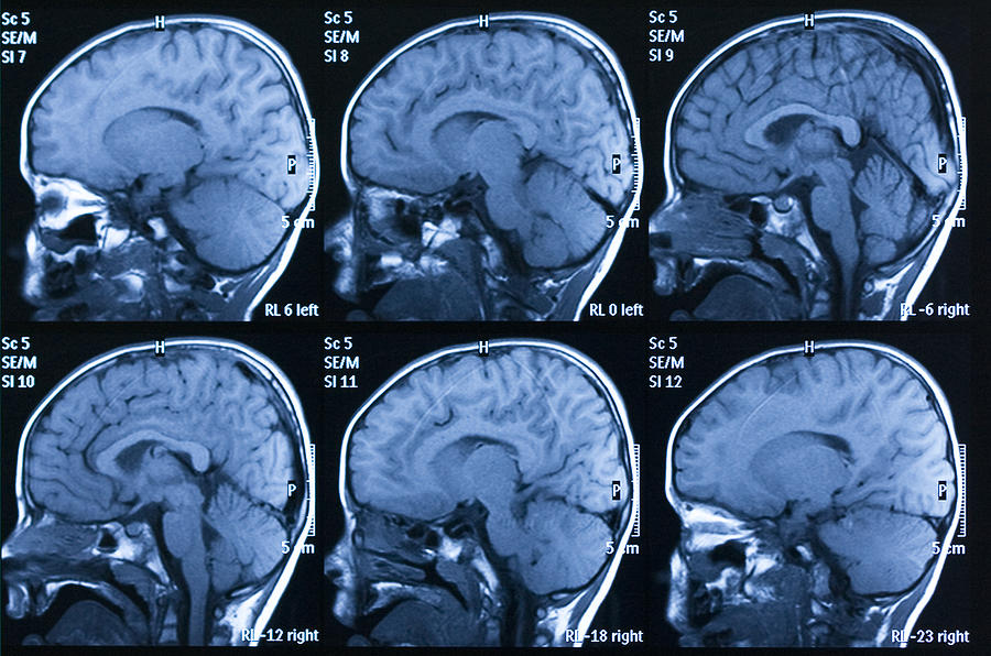 MRI scan of brain Photograph by Temet