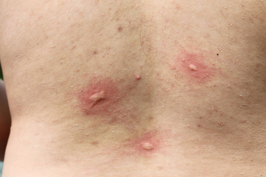 Multiple Mosquito Bites On Body Photograph by Singto2