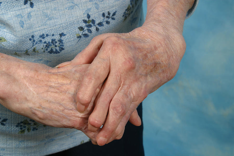 Old person with skin spots on arthritic hands Photograph by StanRohrer
