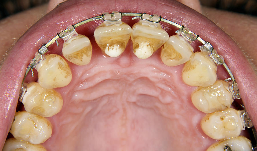 Orthodontic Treatment With Gingival Recesion Photograph by Danielzgombic