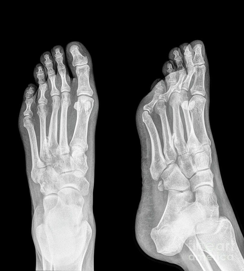 Plantar fasciitis n4 Photograph by Guy Viner | Fine Art America