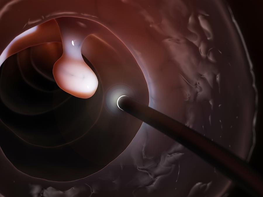 Polyp found during a colonoscopy, artwork Drawing by Sebastian Kaulitzki Polyp found during a colonoscopy, artwork Drawing by Sebastian Kaulitzki