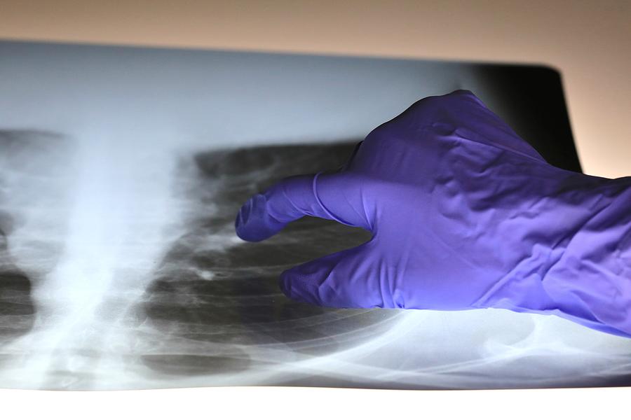 Pulmonologist doctor examines x-ray image of a patient’s lungs and respiratory tract Photograph by Douglas Sacha