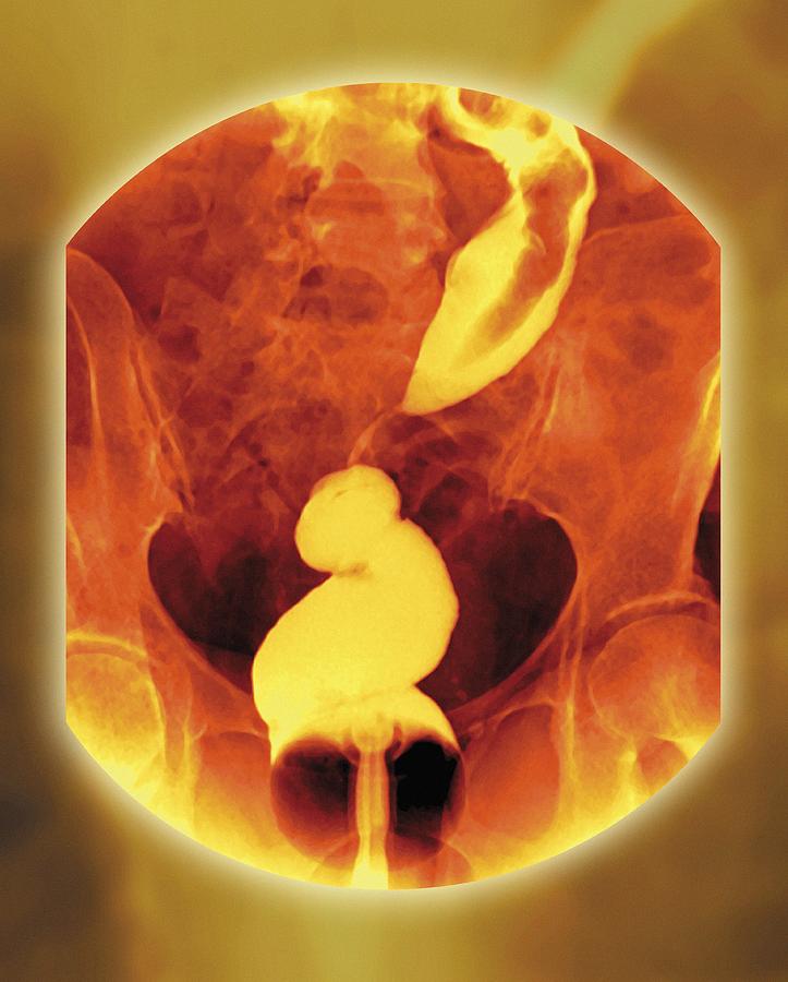 Rectal cancer Photograph by Science Photo Library - MIRIAM MASLO.