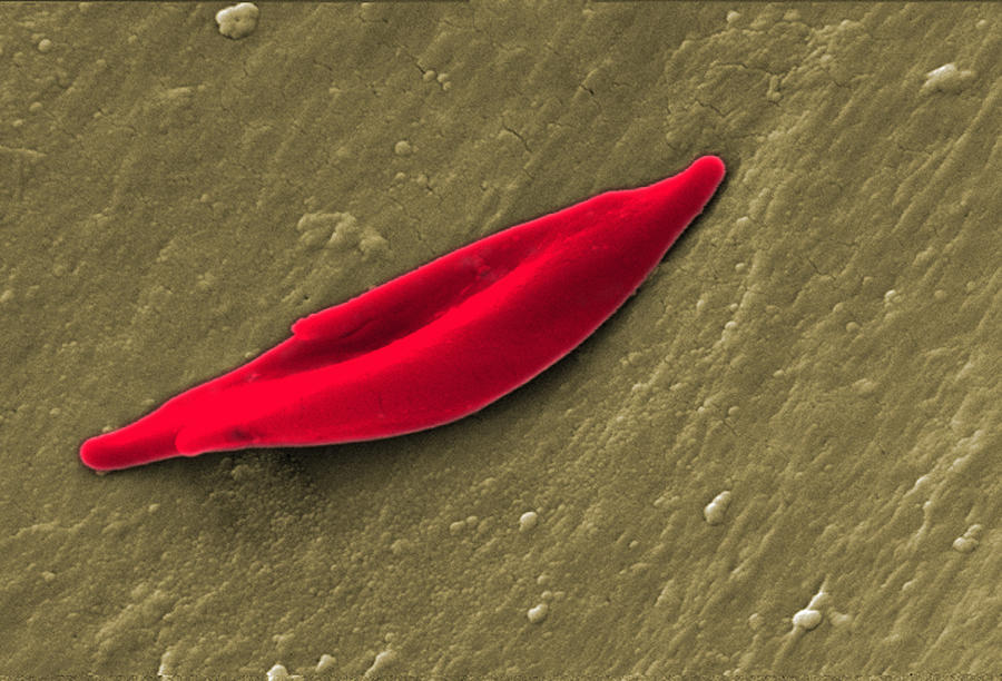 SEM of a sickle cell red blood cell Photograph by Callista Images