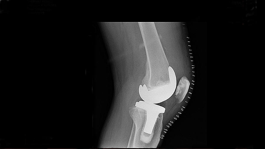 Senior male knee replacement postop Photograph by GSO Images
