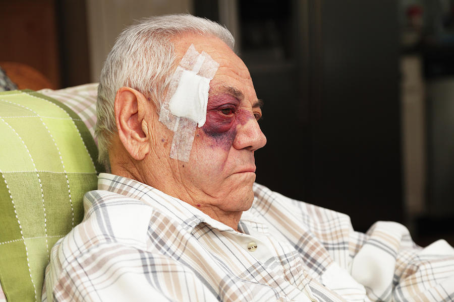 Senior Man With Injured Face and Black Eye is Unhappy Photograph by Willowpix